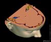 CT 3D skalle
